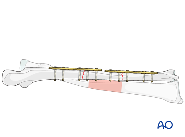 Second fracture fixation