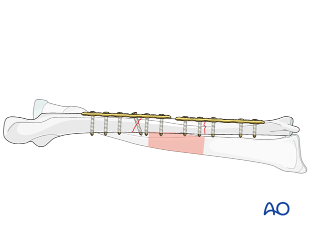 Fixation – using two shorter plates