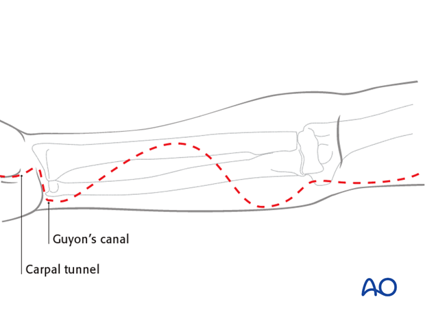 compartment syndrome