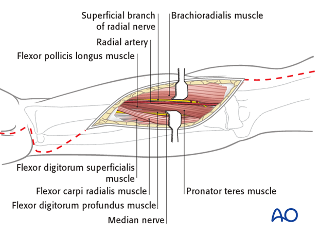 compartment syndrome