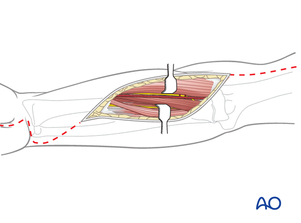 compartment syndrome