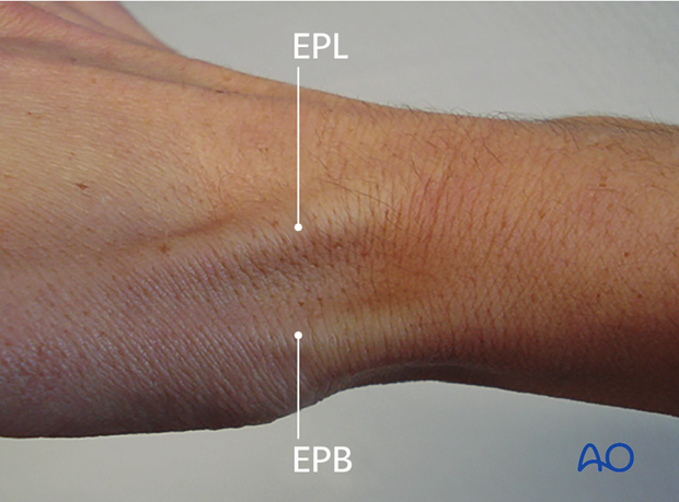 direct approach to the radial styloid