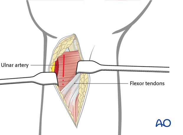 ulnar palmar approach to the distal radius