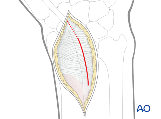 dorsal approach