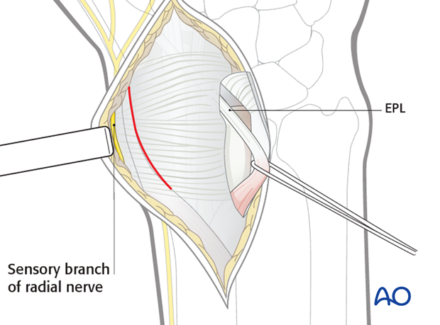 dorsal approach