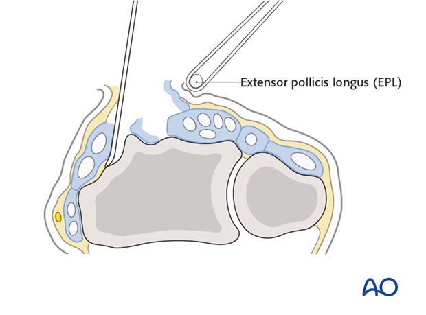 dorsal approach