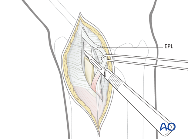 dorsal approach