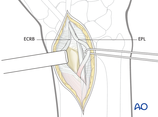 dorsal approach