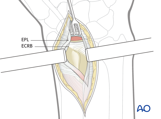 dorsal approach