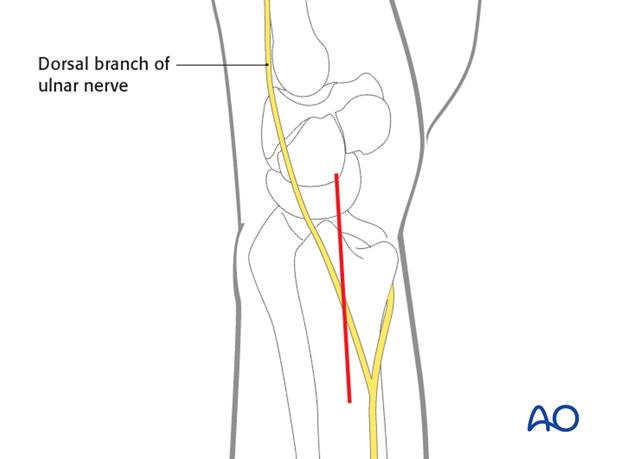 ulnar approach to the distal ulna