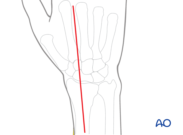 dorsal approach for joint spanning plate