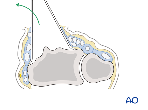 dorsal approach for joint spanning plate