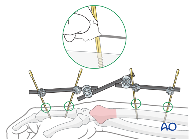 closed reduction k wires and cast external fixator