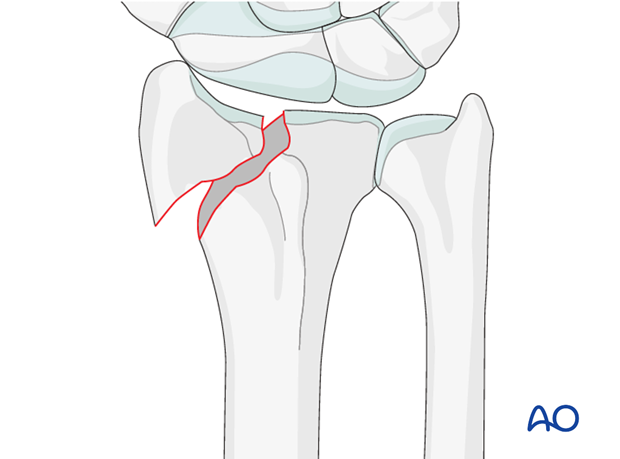 closed reduction k wires and cast external fixator