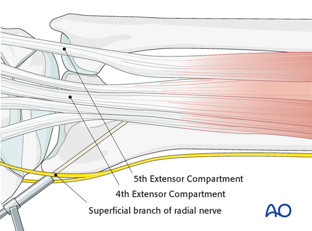 closed reduction k wires and cast external fixator