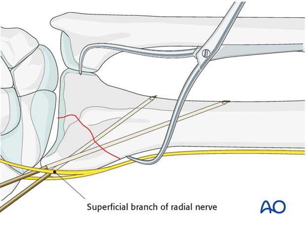 closed reduction k wires and cast external fixator