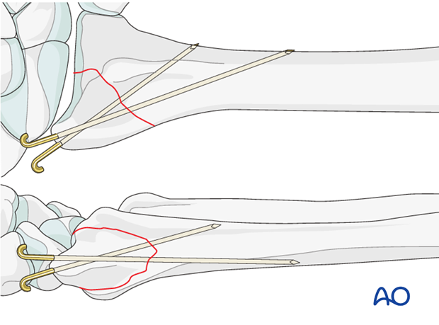 closed reduction k wires and cast external fixator