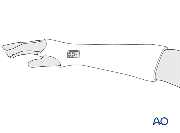 closed reduction k wires and cast external fixator