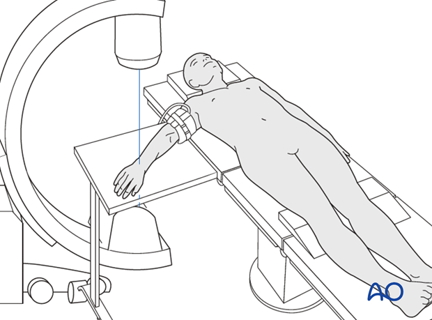 joint spanning external fixation temporary or definitive