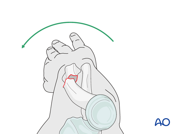 supine dorsal approach