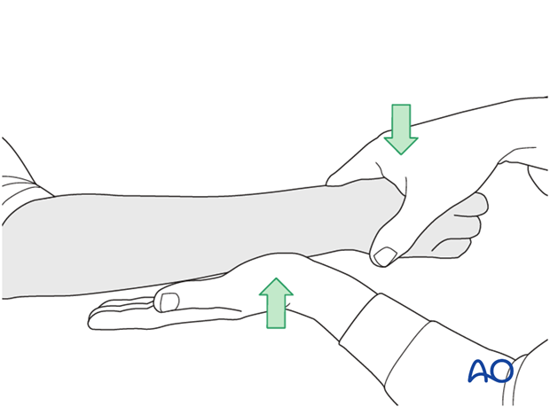 external fixation