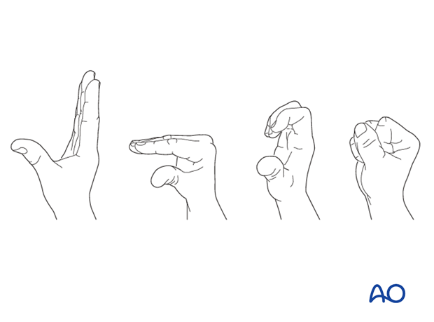 joint spanning external fixation temporary or definitive