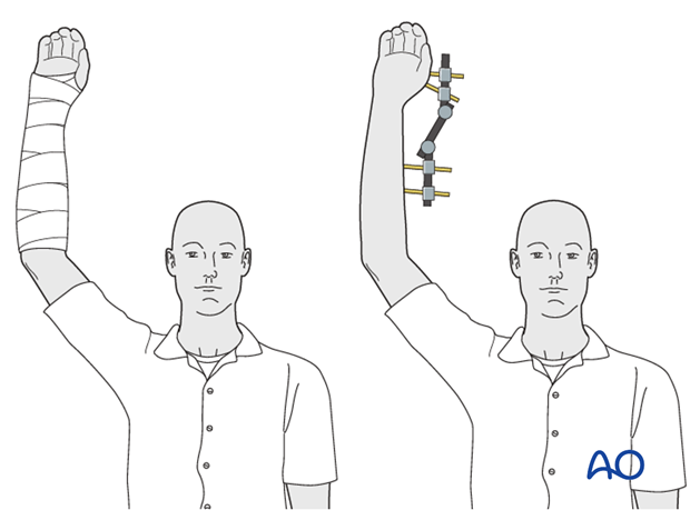 closed reduction k wires and cast external fixator