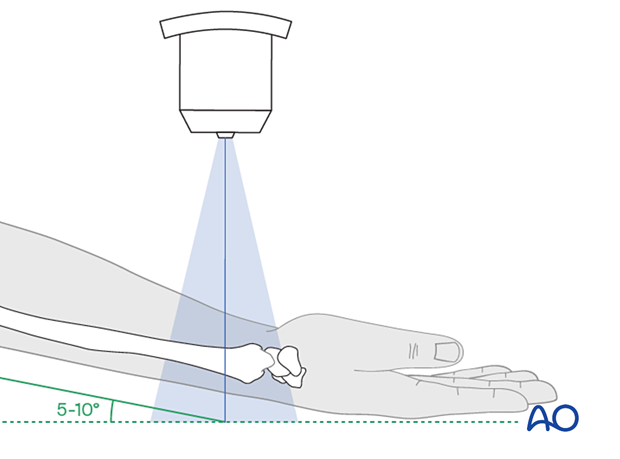 Positioning of the forearm and wrist for optimal AP tangential view