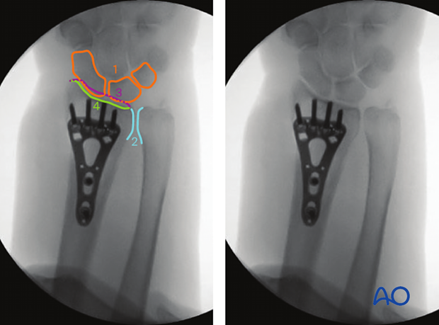 Anatomical lines and landmarks of the distal forearm and wrist in AP view