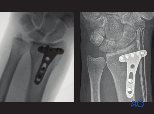 Intraoperative view not centered and centered on the DRUJ 