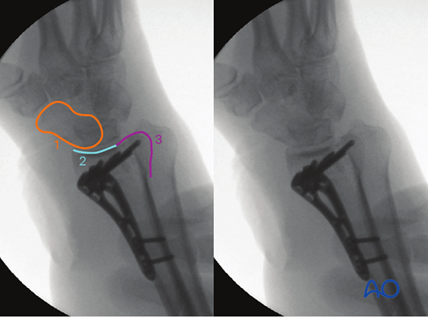 Anatomical lines and landmarks of the distal forearm and wrist in the oblique dorsoulnar or pronation view