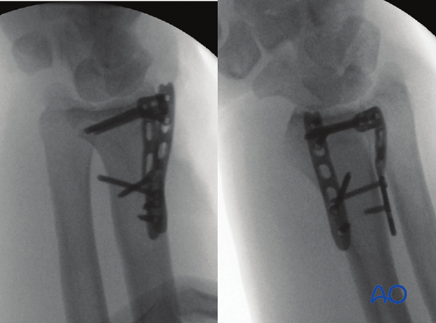 Dorsoradial and dorsoulnar view of the distal forearm and wrist with plate fixation of the distal radius