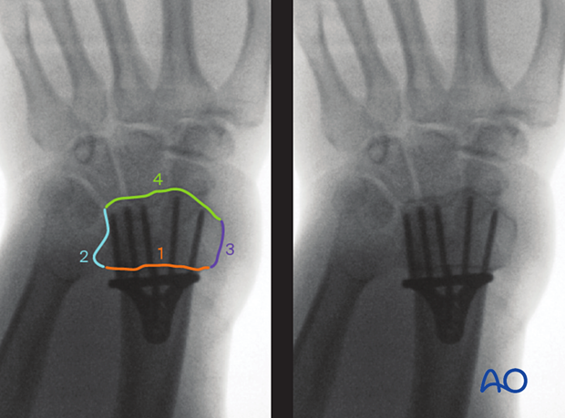 Anatomical lines and landmarks of the distal forearm and wrist in the skyline view