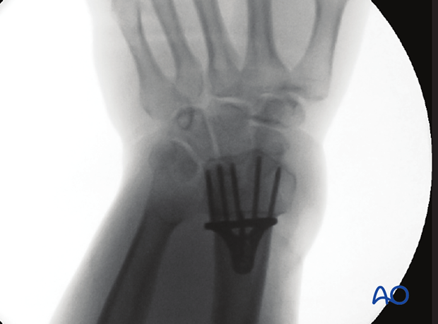 Correct intraoperative skyline view of the distal forearm and wrist