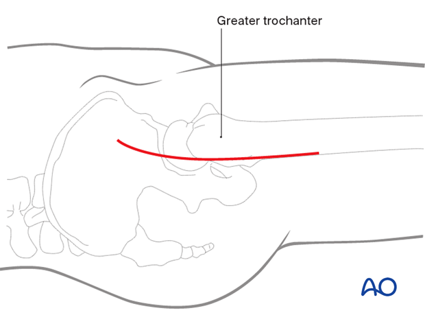 Slightly anteriorly curved skin incision for the anterolateral approach (Watson-Jones) to the proximal femur