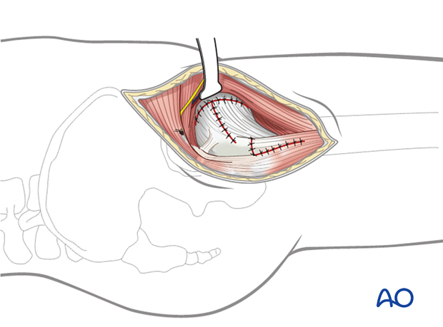 Closure of the hip joint capsule in the anterolateral approach (Watson-Jones) to the proximal femur