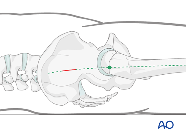 Skin incision for proximal femoral nailing several centimeters proximal to the tip of the greater trochanter