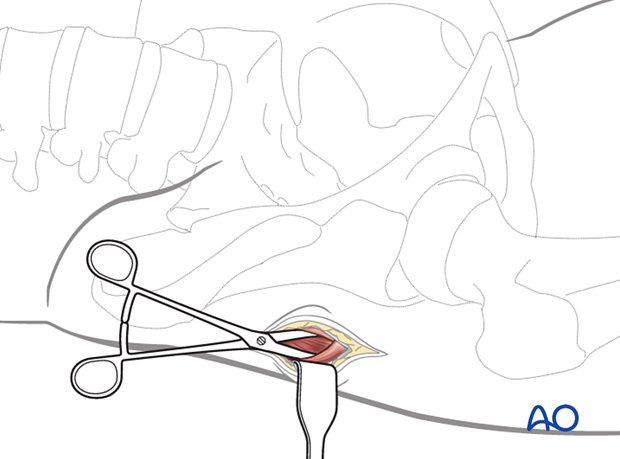 Blunt dissection to gain access to the tip of the trochanter for proximal femoral nailing