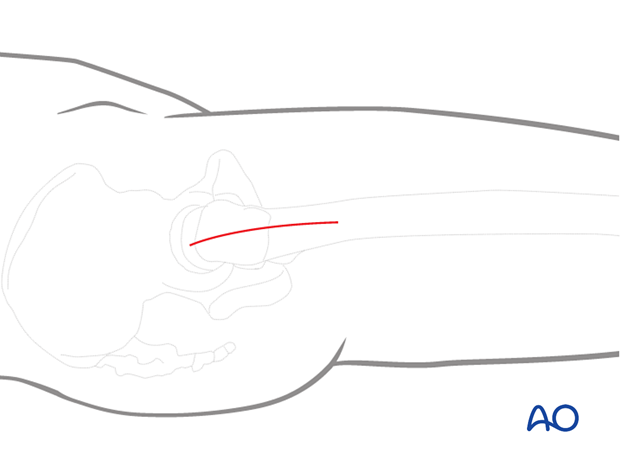 Lateral approach to the proximal femur with a limited longitudinal incision