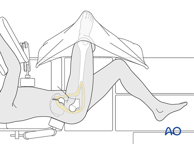 Exposure of the proximal femur in the direct lateral approach by gentle external rotation of the leg