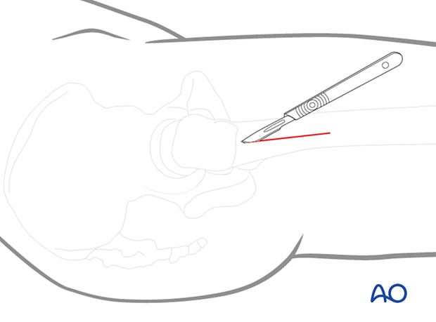 Skin incision of a limited lateral approach for implant insertion in the proximal femur