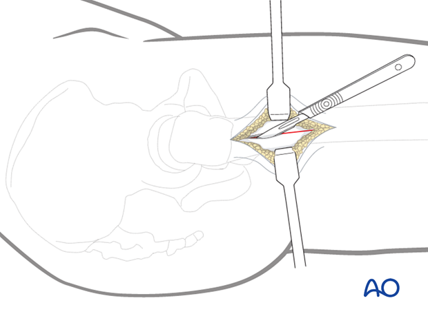 Incision of the iliotibial band during a limited lateral approach for implant insertion in the proximal femur