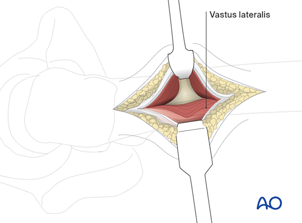 Exposure of the femoral shaft for a limited lateral approach for implant insertion in the proximal femur