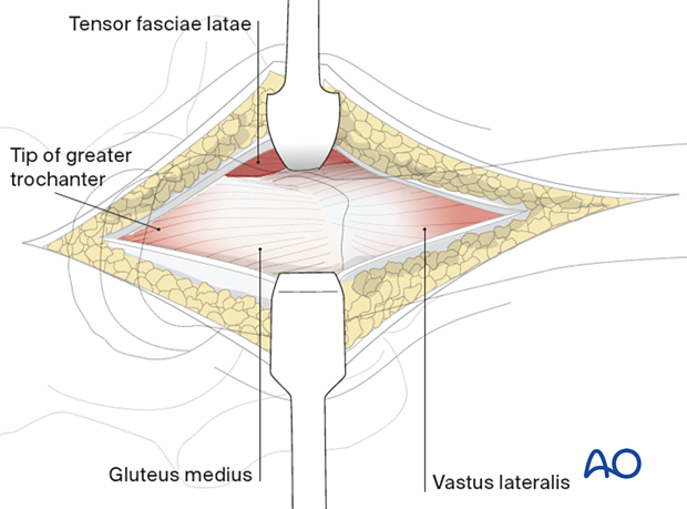 Proximal extension of the incision through the skin and subcutaneous tissue and fascia lata providing access to the proximal surface of the greater trochanter and the gluteus medius insertion