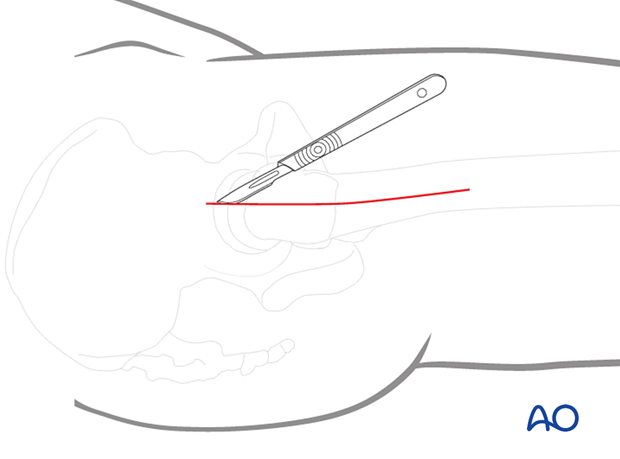 Skin incision of the direct lateral approach to the hip