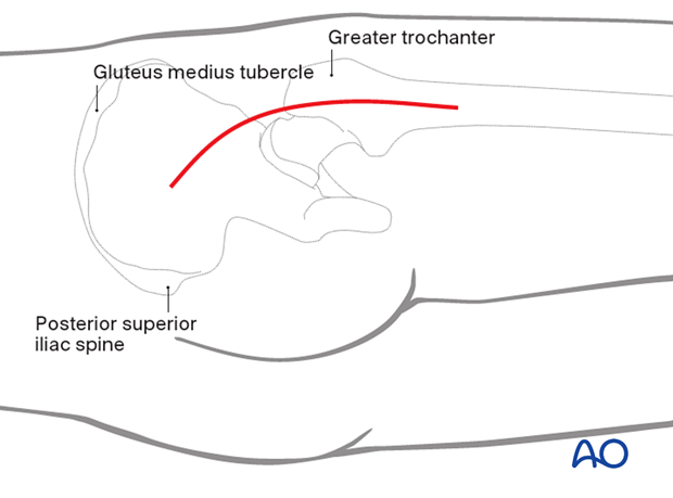 Skin incision of the posterolateral (posterior) approach to the hip