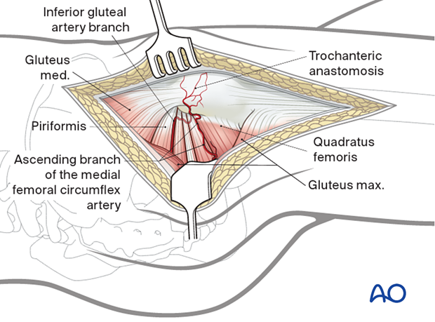 Trochanteric anastomosis and inferior gluteal artery branch, two vascular landmarks in the trochanteric flip osteotomy through the Gibson interval