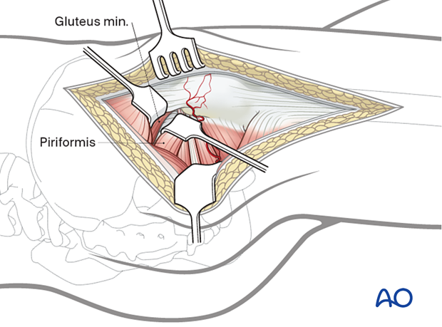 Developing the minimus-piriformis interval in the trochanteric flip osteotomy through the Gibson interval