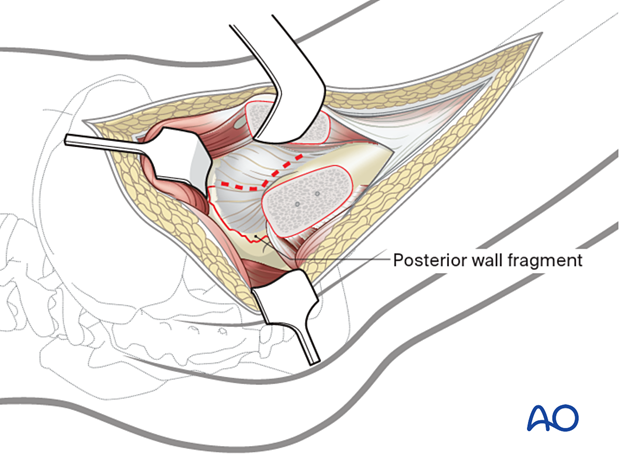 Capsulotomy after trochanteric flip osteotomy in the presence of a posterior wall fragment