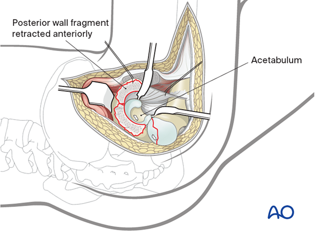 Surgical dislocation of the hip joint after trochanteric flip osteotomy by gentle external rotation of the leg with exposure of the femoral head and retracted posterior wall fragment